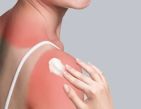 sunburn