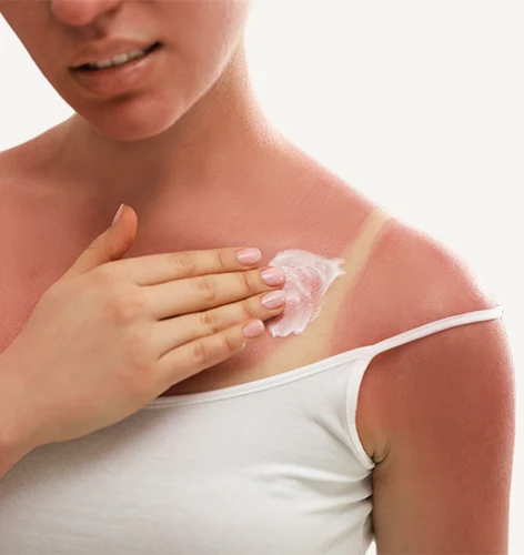 sunburn cream Epicalm Plus aplied to neck and neckline sunburn cream Epicalm Plus aplied to neck and neckline
