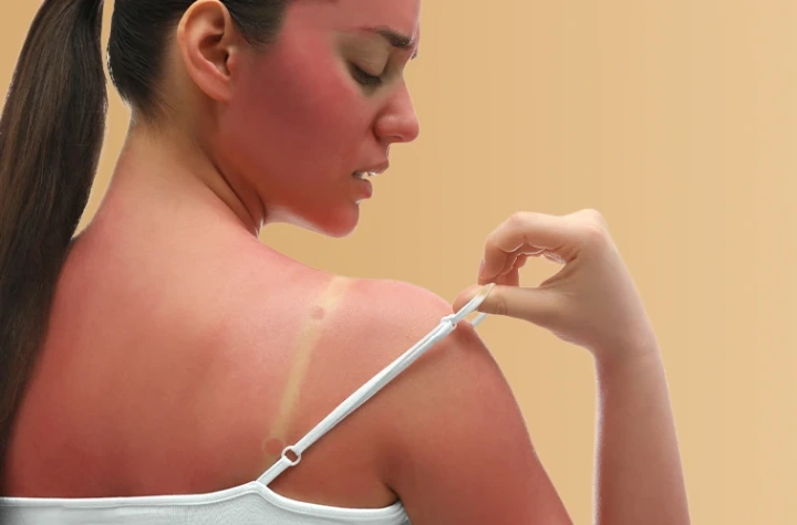 sunburn