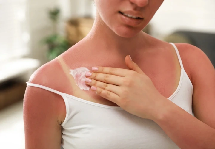 Proper application of moisturizing cream to sunburned skin for hydration and healing