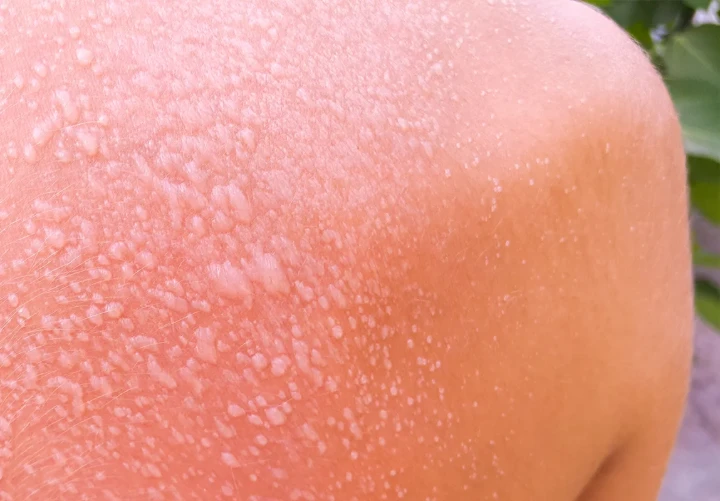 Doctor examining severe sunburn with blisters requiring professional medical treatment