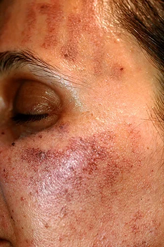 Iperpigmentazione post-infiammatoria dopo trattamento laser (IPL) su fronte e guance di una donna con fototipo III-IV Iperpigmentazione post-infiammatoria sulla fronte di una donna con fototipo 3-4, che si manifesta sotto forma di macchie rettangolari distinte