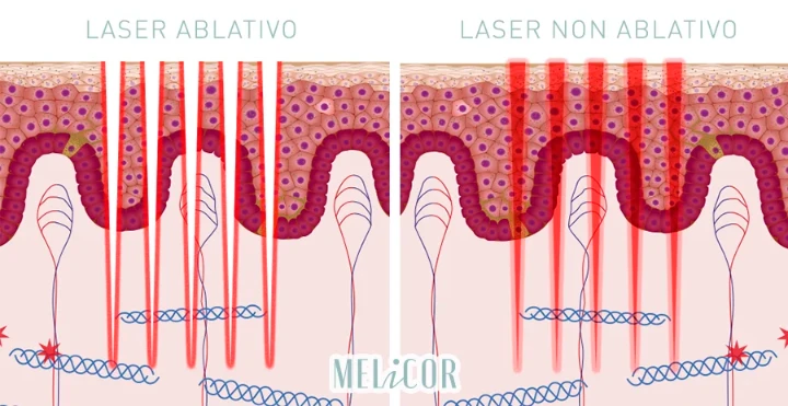 Ablative und nicht-ablative Laserbehandlungsmethoden, Wirkungsmechanismus auf der Haut