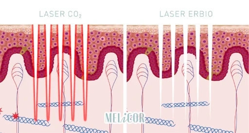 Vergleich von CO₂- und Erbium-Lasern: Eindringtiefe in die Haut